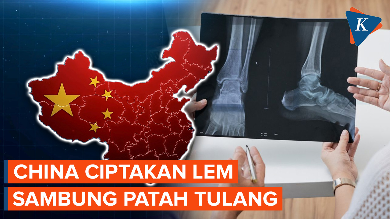 China Kembangkan Lem yang Bisa Rekatkan Tulang Patah dalam 3 Menit