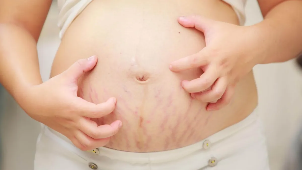 Làm thế nào để hết ngứa vết rạn? Nguyên nhân và cách xử lý hiệu quả tại nhà - Đại Bắc Care