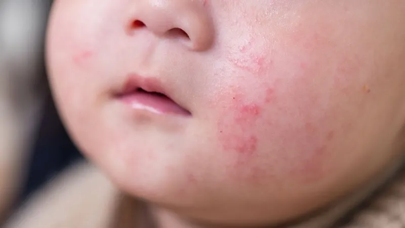 Gợi ý 6 dòng kem bôi chàm sữa dịu nhẹ, giúp da bé nhanh phục hồi - Đại Bắc Care