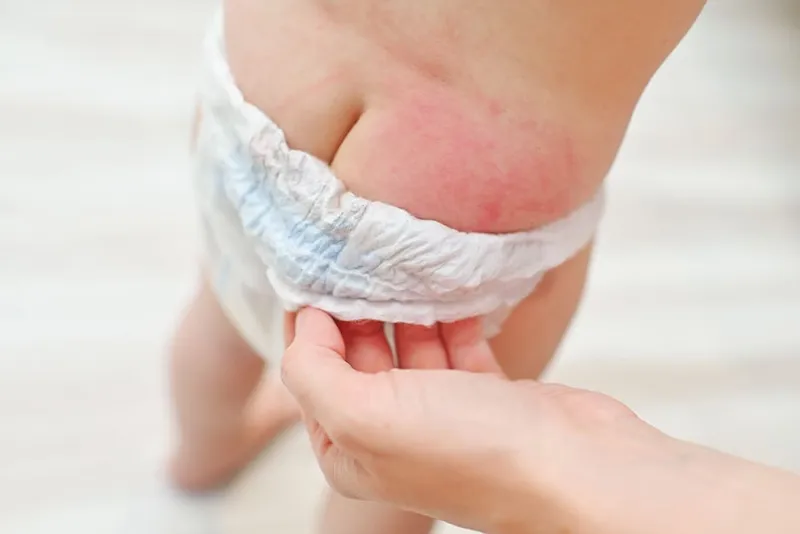 [Review] Kem chống hăm cho trẻ sơ sinh loại nào tốt, thân thiện với da bé? - Đại Bắc Care